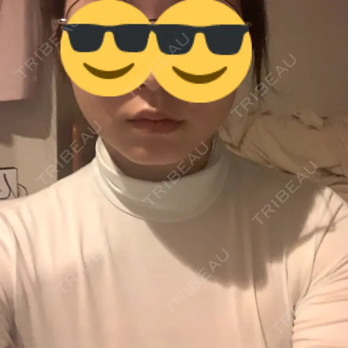 ヒアルロン酸注入（あご） TCB東京中央美容外科 池袋西口院 BEFORE メイン用