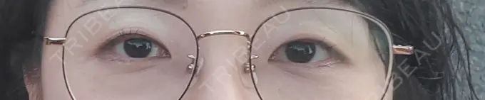 二重切開 ティーズクリニック BEFORE メイン用