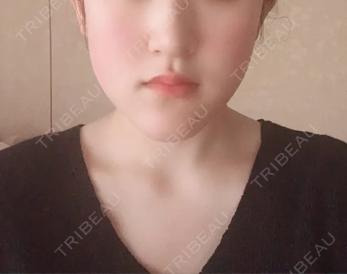 骨切り（あご） / ルフォー+ssro（両あご) 東京美容外科 赤坂院 BEFORE メイン用