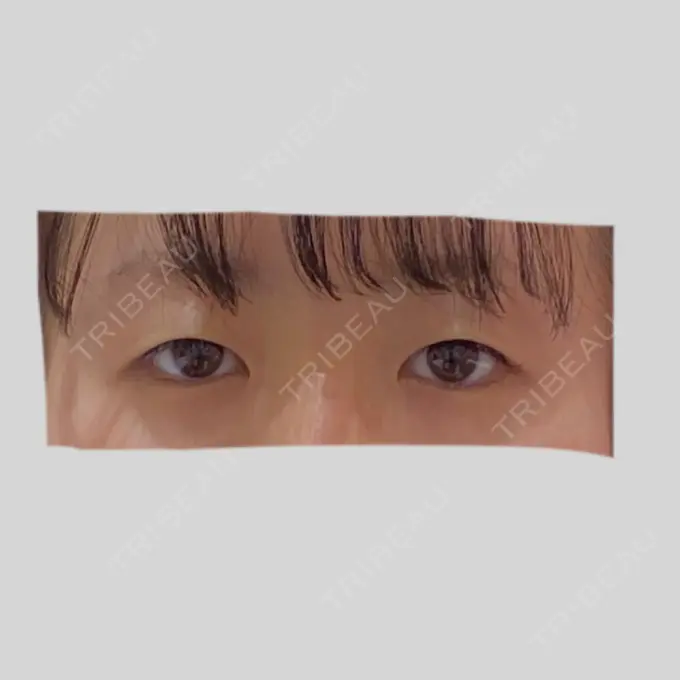 二重切開 / 目頭切開 / 眼瞼下垂（切開） / 目尻切開 RG整形外科（旧リオン整形外科） BEFORE メイン用