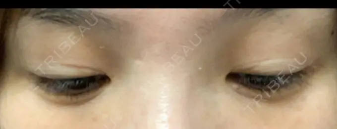 二重埋没 / 目頭切開 / 目尻切開 / タレ目形成・グラマラスライン（切開） RG整形外科（旧リオン整形外科） BEFORE メイン用