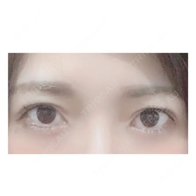 二重切開 / 目頭切開 / 眼瞼下垂（切開） RG整形外科（旧リオン整形外科） BEFORE メイン用