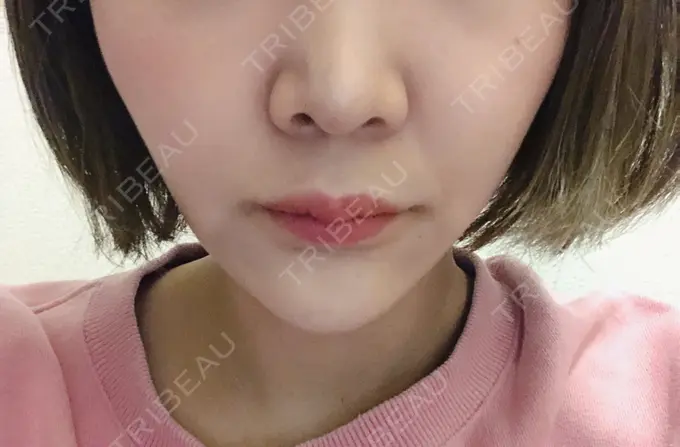 人中短縮 新宿ラクル美容外科クリニック 新宿院 BEFORE メイン用