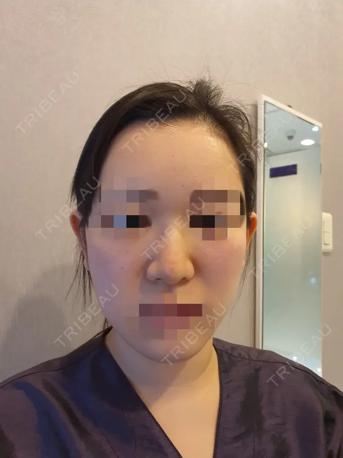 小鼻縮小（切開） / 骨切り（あご） / 骨削り（エラ） / 骨削り（頬） / バッカルファット除去 / 脂肪吸引（顔） / 軟骨移植 RG整形外科（旧リオン整形外科） BEFORE メイン用
