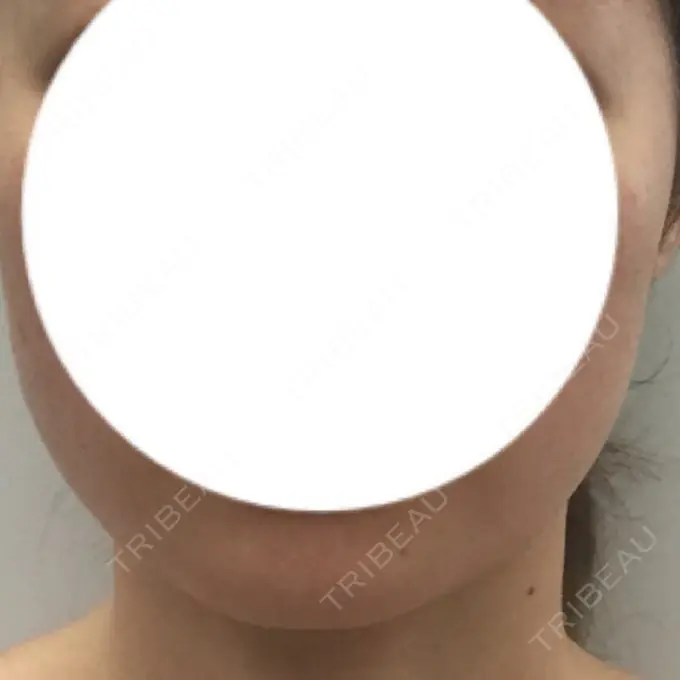 ボトックス（エラ・小顔） 湘南美容クリニック 仙台院 BEFORE メイン用