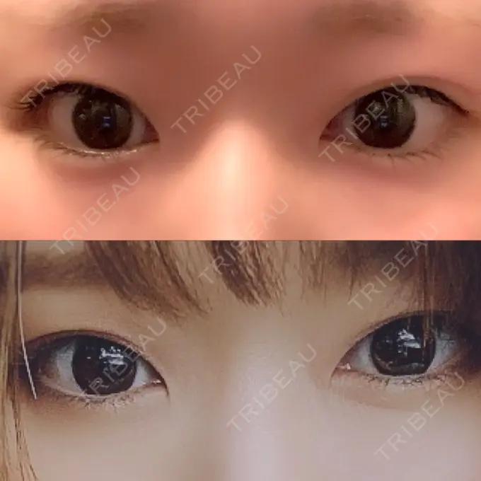 二重埋没 湘南美容クリニック 金沢院 BEFORE メイン用