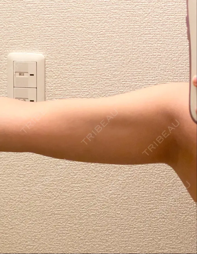 脂肪吸引（二の腕） 広島プルミエクリニック BEFORE メイン用