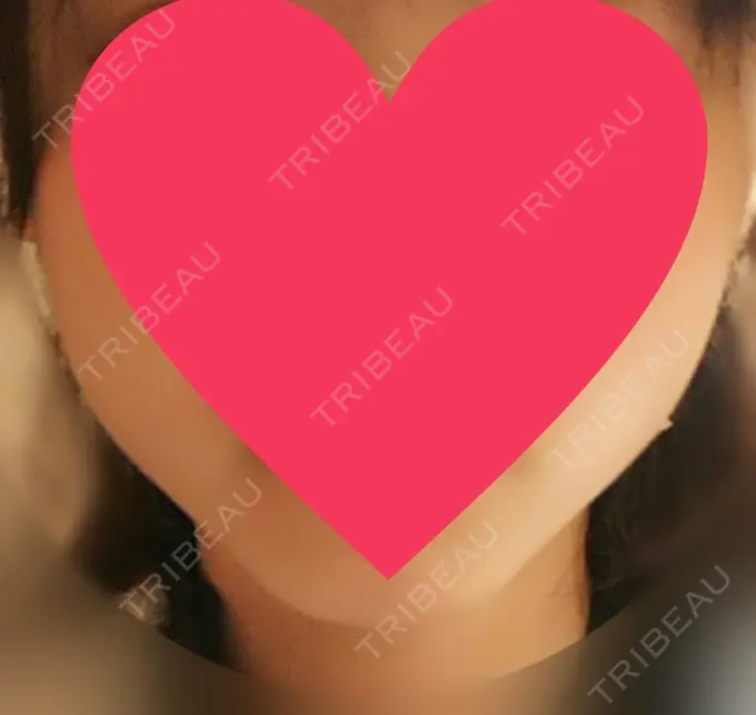 ハイフ（顔） 赤坂プレミアクリニック BEFORE メイン用