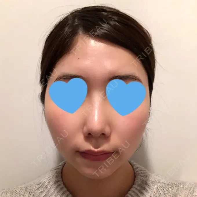 糸リフト / 骨切り（あご） / 骨削り（頬） / 脂肪吸引（顔） RG整形外科（旧リオン整形外科） BEFORE メイン用