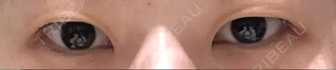 二重埋没 / 上まぶたの脂肪取り 湘南美容クリニック 柏院 BEFORE メイン用