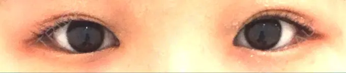 二重切開 / 上まぶたの脂肪取り 品川スキンクリニック広島院 BEFORE メイン用