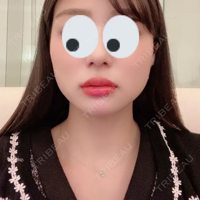 ボトックス（あご） / ヒアルロン酸注入（あご） / ボトックス（エラ・小顔） / 脂肪溶解注射（顔） クリニックA.O. BEFORE メイン用