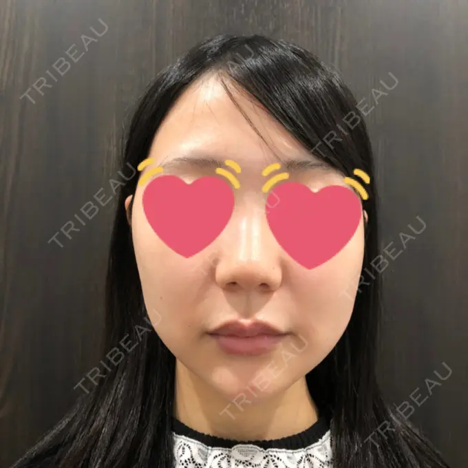 糸リフト / ボトックス（エラ・小顔） / ヒアルロン酸注入（唇） ルラ美容クリニック 高田馬場院 BEFORE メイン用