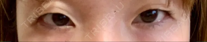 二重埋没 湘南美容クリニック 札幌院 BEFORE メイン用