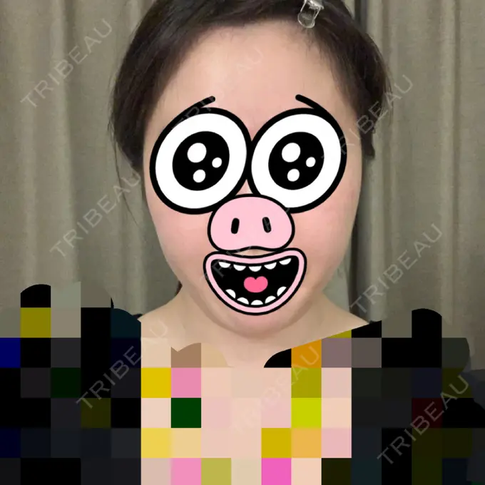 糸リフト / 骨切り（あご） / 骨削り（エラ） / 骨削り（頬） / 脂肪吸引（顔） / 脂肪注入（輪郭） RG整形外科（旧リオン整形外科） BEFORE メイン用