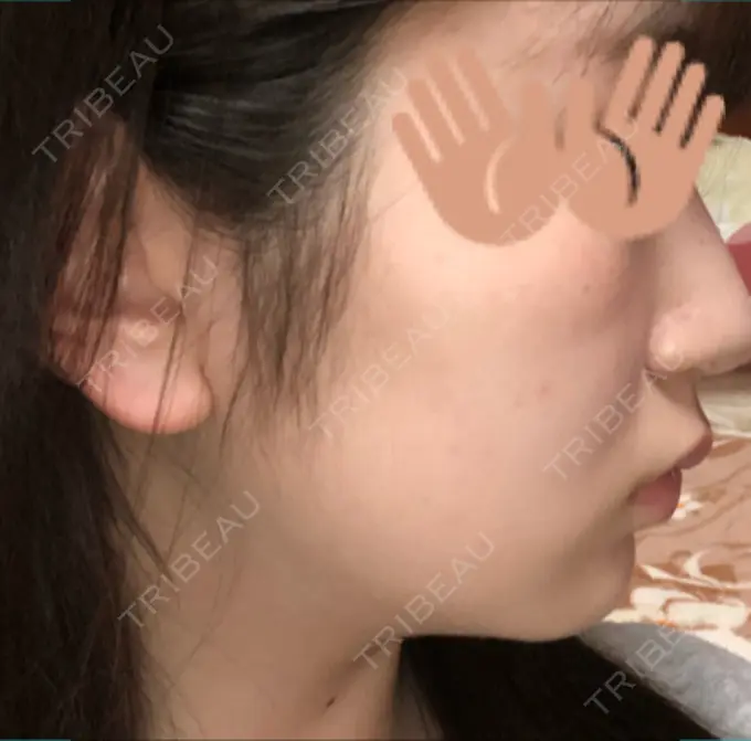 脂肪溶解注射（顔） / ヒアルロン酸注入（頬） 赤坂プレミアクリニック BEFORE メイン用