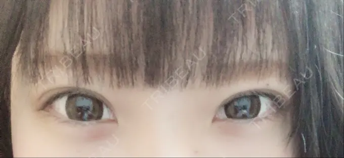 ヒアルロン酸注入（涙袋） アネシス美容クリニック BEFORE メイン用