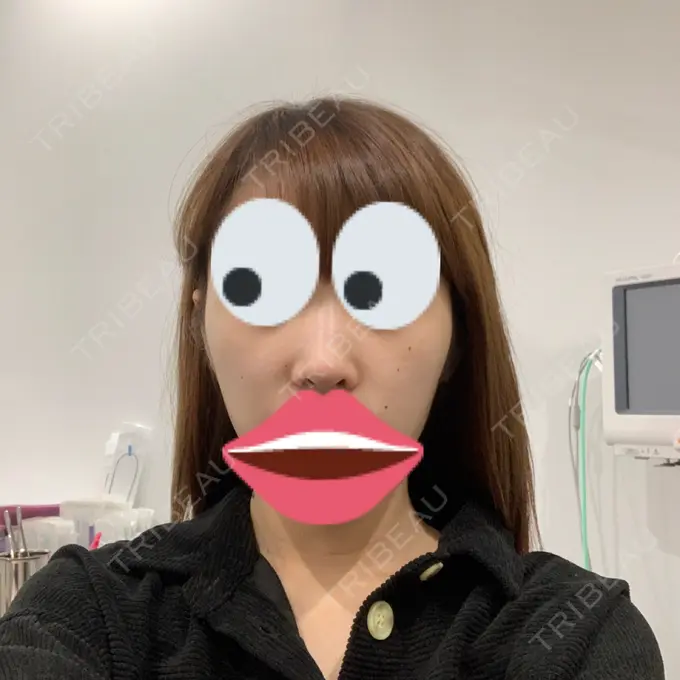 隆鼻術 / 鼻尖形成（切開） / 小鼻縮小（切開） / ボトックス（エラ・小顔） / その他（鼻） ルラ美容クリニック 高田馬場院 BEFORE メイン用