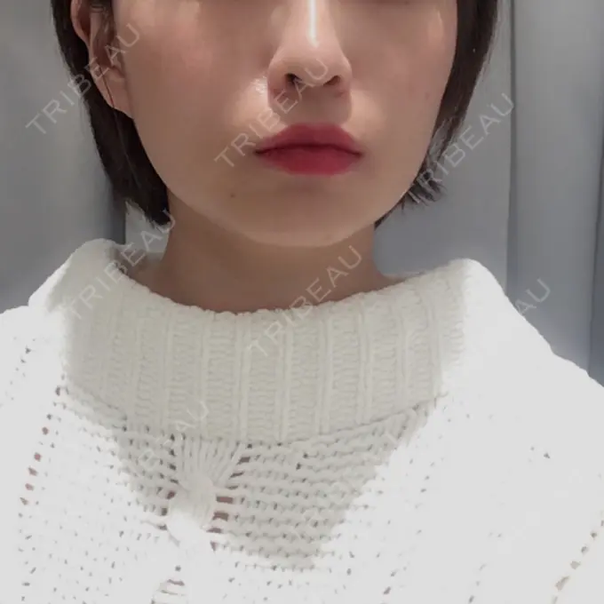 鼻中隔延長（切開） / ヒアルロン酸注入（あご） あいちビューティークリニック栄本院 BEFORE メイン用