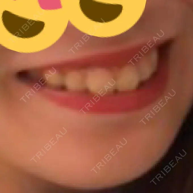 ホワイトニング ティースアート　新宿店 BEFORE メイン用