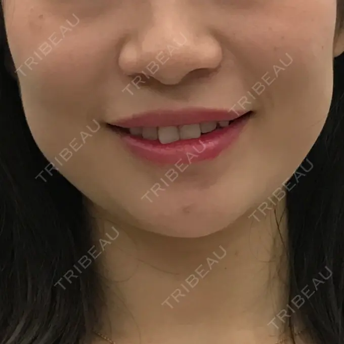 ボトックス（エラ・小顔） / 脂肪溶解注射（顔） 湘南美容クリニック 仙台院 BEFORE メイン用