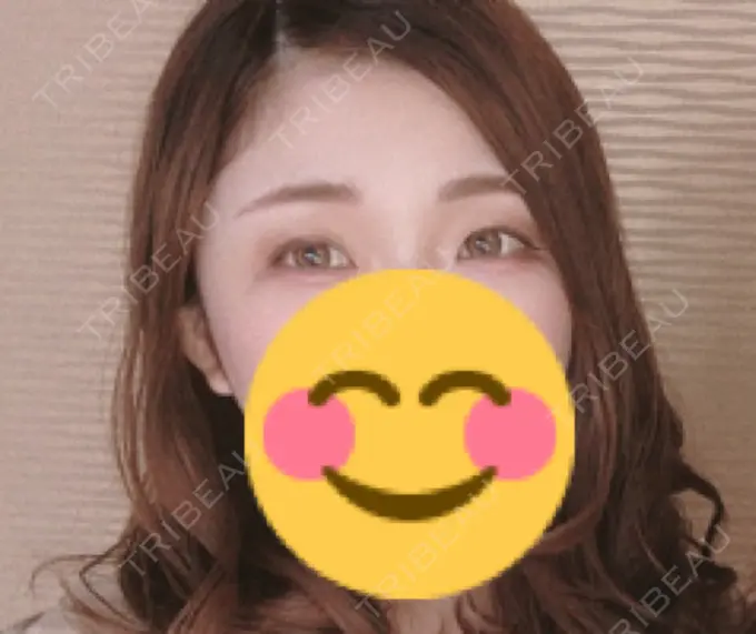 二重切開 品川スキンクリニック広島院 BEFORE メイン用