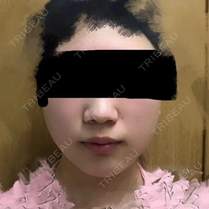 バッカルファット除去 / 脂肪吸引（顔） ジョウクリニック 大阪院 BEFORE メイン用