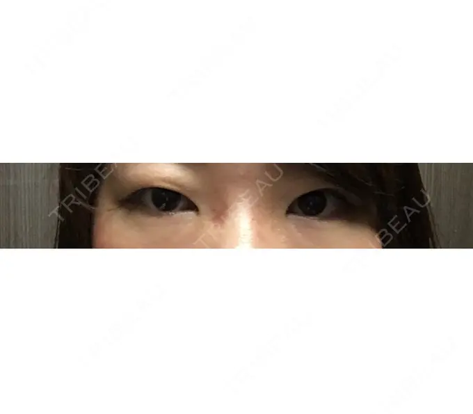 二重埋没 青山セレスクリニック 青山院 BEFORE メイン用