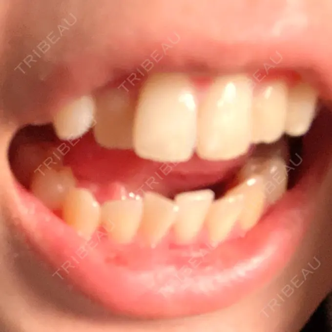 矯正（ワイヤー） アトラスタワー歯科 BEFORE メイン用