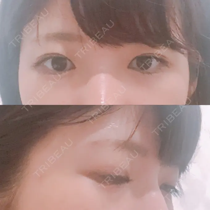 脂肪溶解注射（まぶた） 銀座フェイスクリニック（小顔整形・輪郭整形專門） BEFORE メイン用