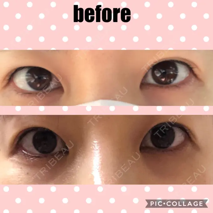 二重切開 マリアクリニック 安城院 BEFORE メイン用