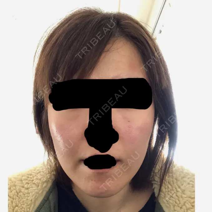 脂肪吸引（顔） アサミ美容外科 渋谷院 BEFORE メイン用