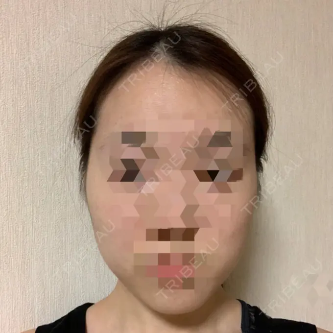 糸リフト / 骨切り（あご） / 骨削り（エラ） RG整形外科（旧リオン整形外科） BEFORE メイン用