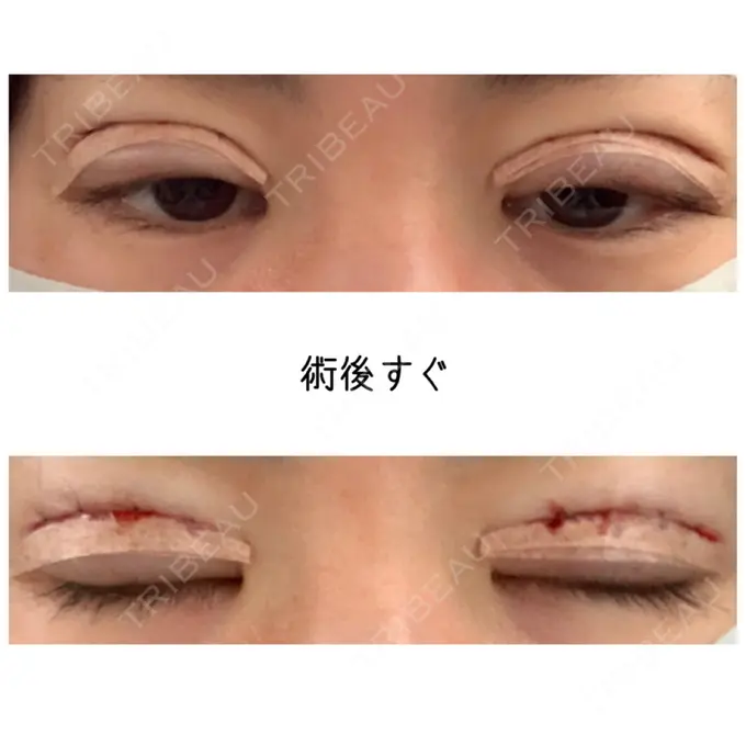 二重切開 久留米総合美容外科 BEFORE メイン用