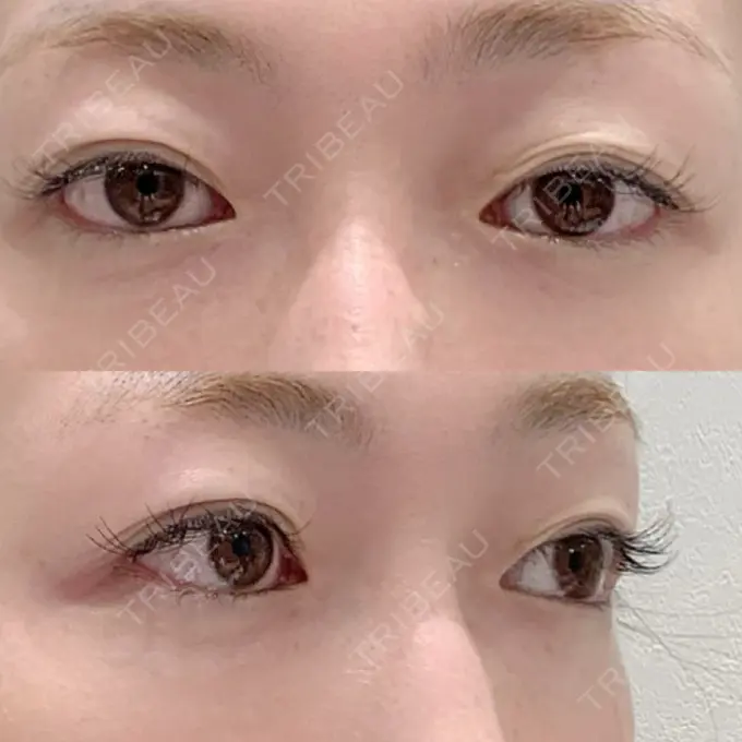 二重埋没 / 眼瞼下垂（切開） BIANCA表参道 BEFORE メイン用