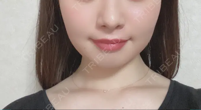 脂肪溶解注射（顔） 赤坂プレミアクリニック BEFORE メイン用