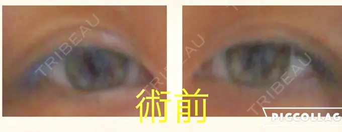 眼瞼下垂（切開） ブリスクリニック形成外科・美容外科・美容皮膚科 福岡 BEFORE メイン用