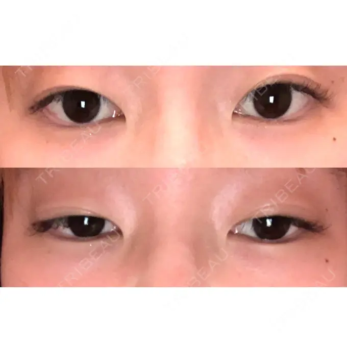 二重埋没 共立美容外科 柏院 BEFORE メイン用