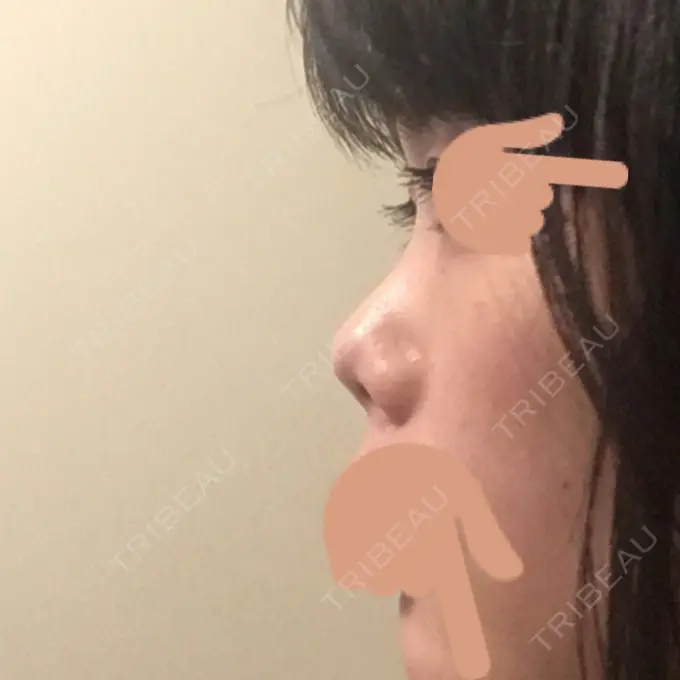 隆鼻術 / 鼻中隔延長（切開） / 斜鼻修正 / 真皮移植 / 鼻孔縁下降 加藤クリニック 麻布東京院 BEFORE メイン用