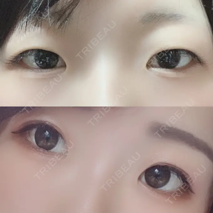 二重埋没 / 上まぶたの脂肪取り いわきタウン形成外科クリニック BEFORE メイン用