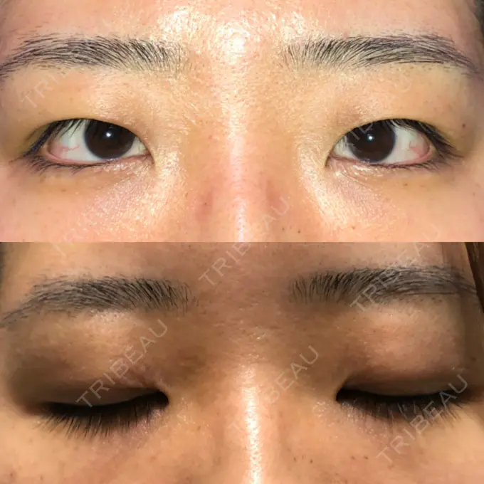 二重切開 / 目頭切開 / その他（目元） 新前橋かしま眼科形成外科クリニック BEFORE メイン用