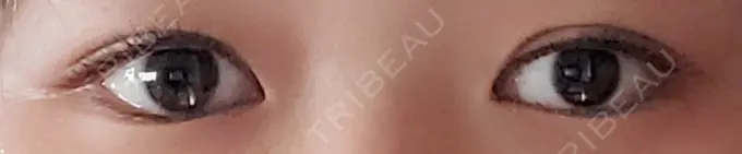 二重埋没 城本クリニック 名古屋院 BEFORE メイン用