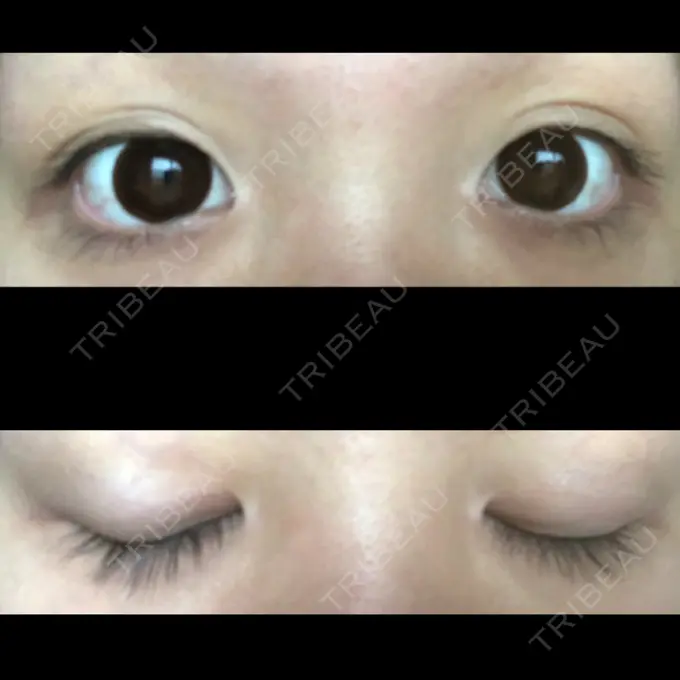 二重埋没 かわた美容クリニック BEFORE メイン用