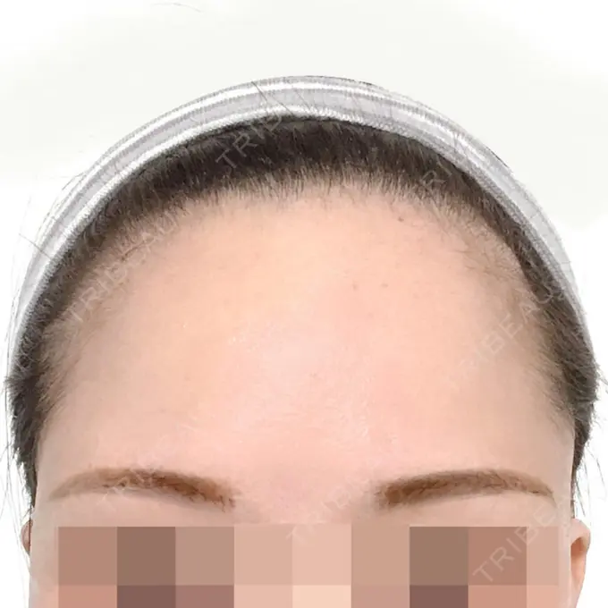 その他（肌） F5整形外科 BEFORE メイン用