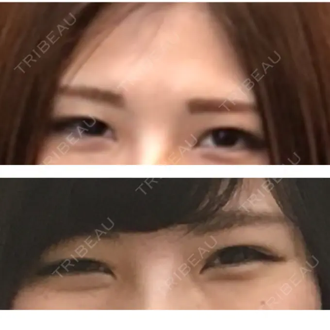 眼瞼下垂（切開） / その他（肌） La Clinique Shinjuku 【ラクリニック 新宿】 BEFORE メイン用