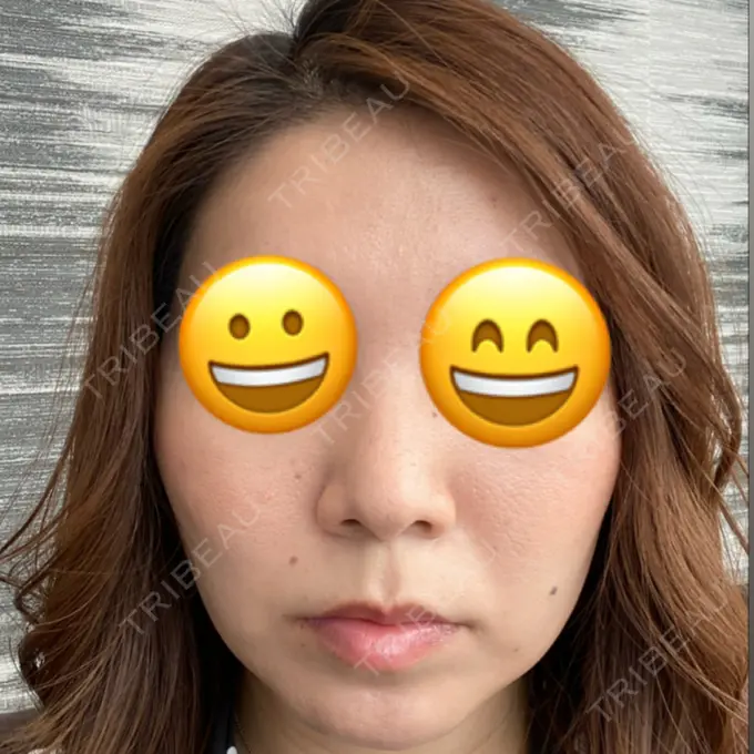 レディエッセ注入（鼻） LETICIA CLINIC（レティシア クリニック） BEFORE メイン用