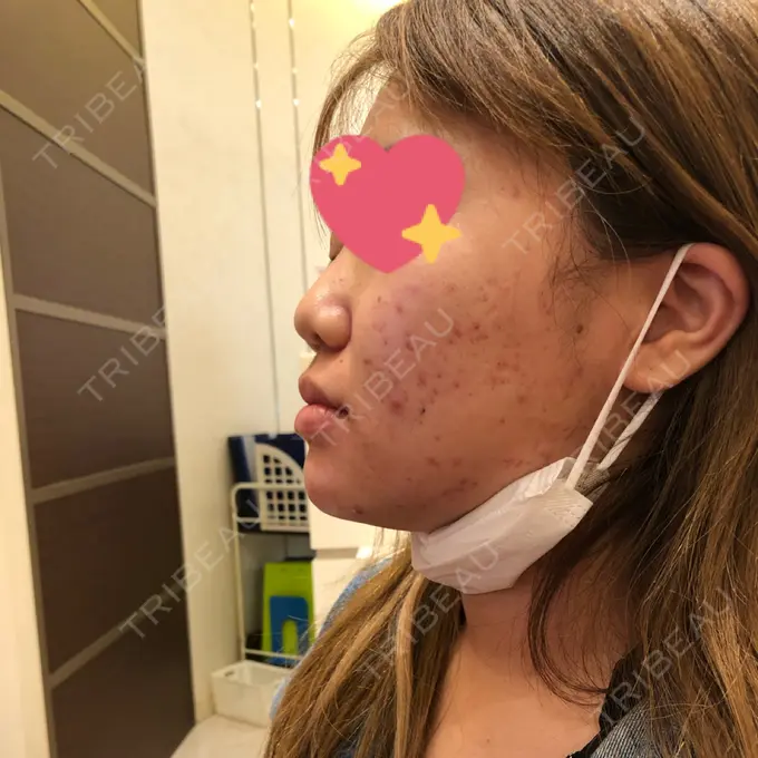 ヒアルロン酸注入（鼻） 品川美容外科 福岡院 BEFORE メイン用