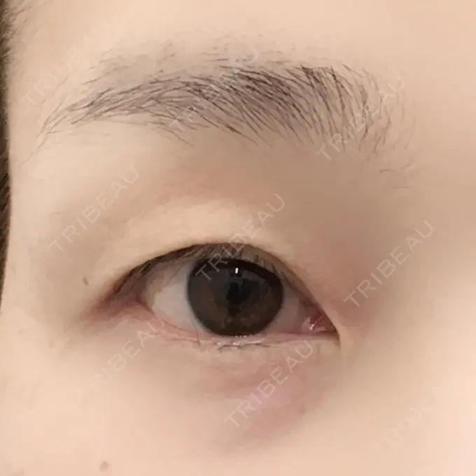 眉下切開 湘南美容クリニック 秋葉原院 BEFORE メイン用