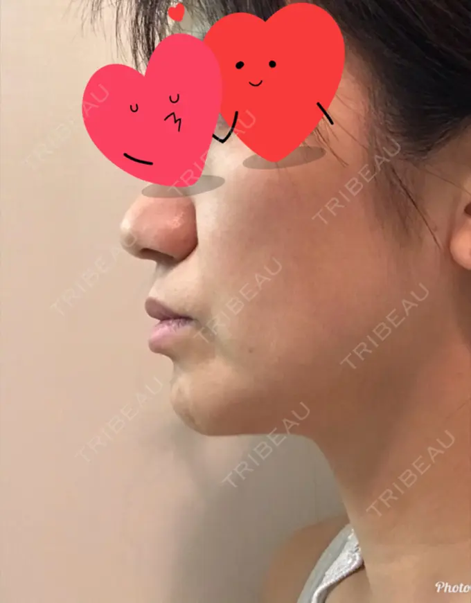 脂肪溶解注射（顔） TCB東京中央美容外科 心斎橋筋院 BEFORE メイン用