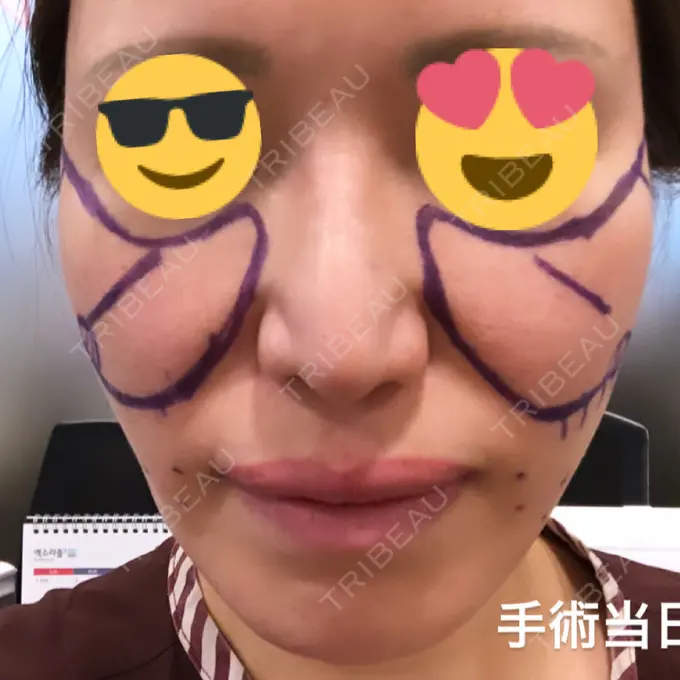 その他（目元） スノウ（Snow）整形外科 BEFORE メイン用